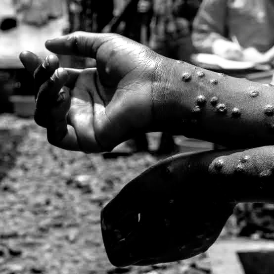 Mpox Crisis in Africa: One Year After WHO Emergency Declaration